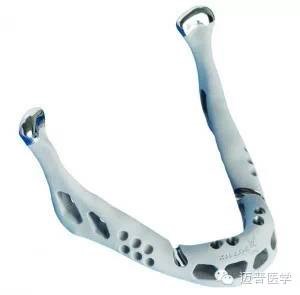 3D打印技術(shù)在骨科個(gè)體化治療方面的優(yōu)勢和應(yīng)用